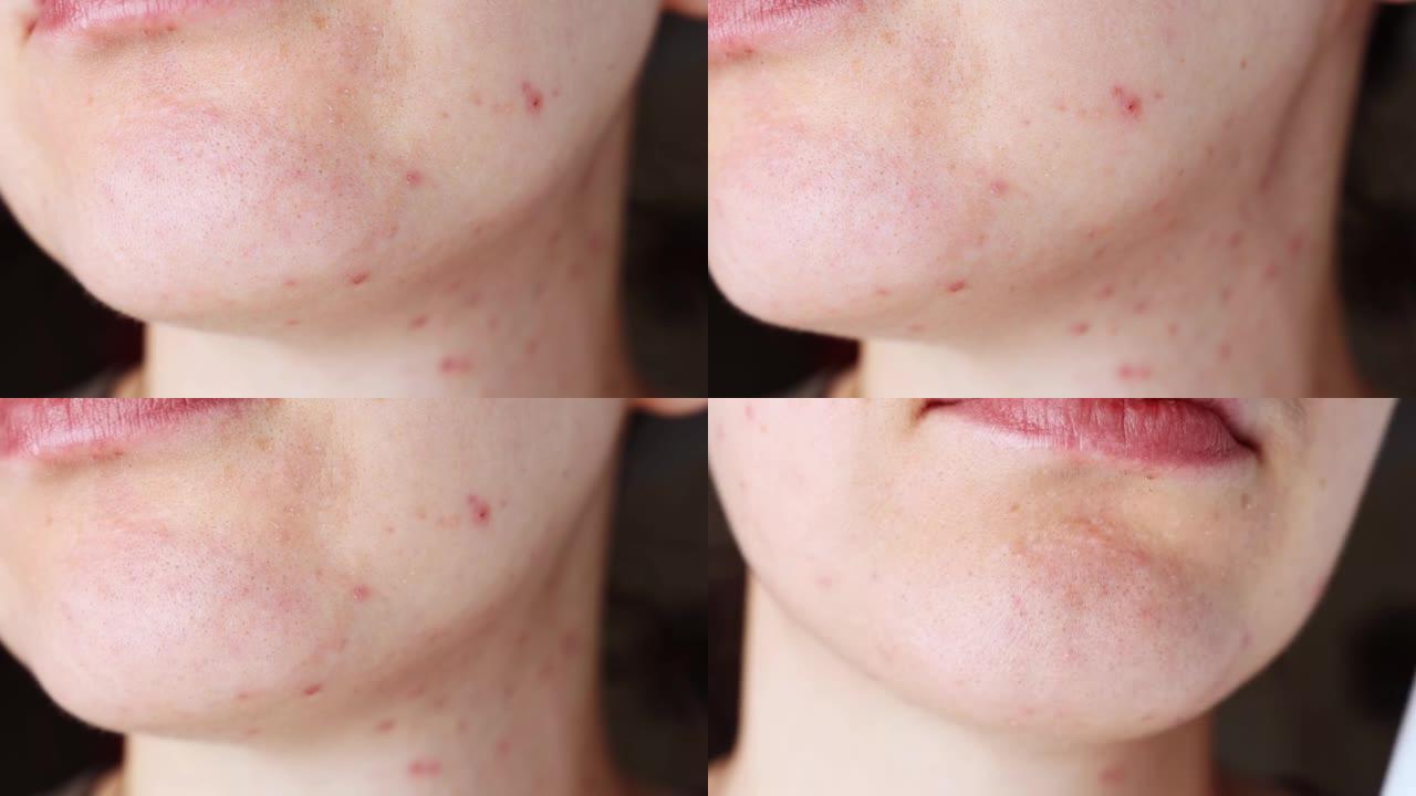 患病的女性面部皮肤有丘疹，痤疮和黑点特写。