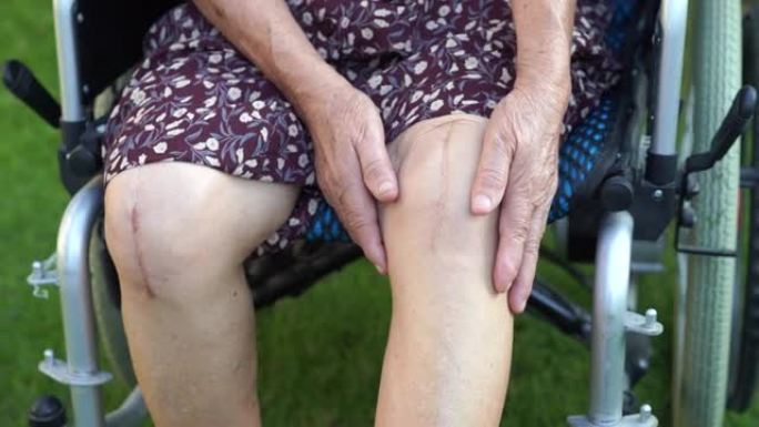 亚洲老年或老年老太太患者显示她的疤痕手术全膝关节置换缝合伤口手术关节置换术在轮椅护理医院病房: 健康