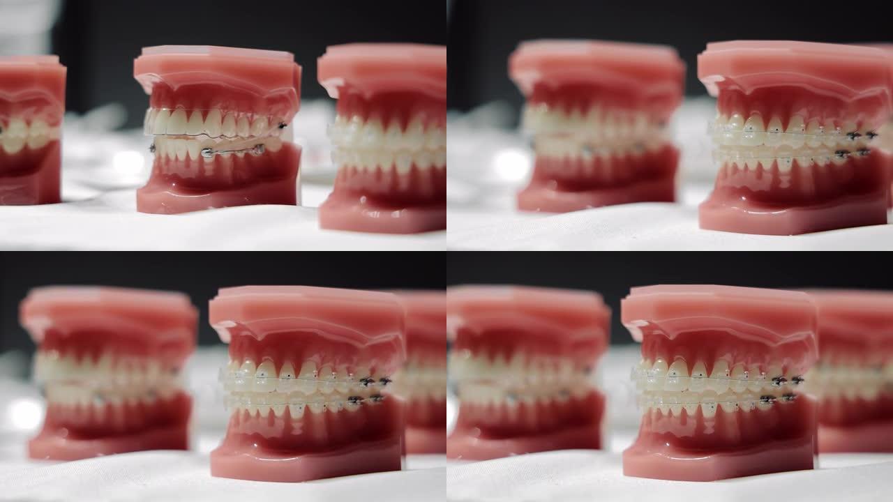 牙齿间隙在正畸托槽放置上的模型。在不同布局上放置和固定正畸医生的变体。牙齿异常