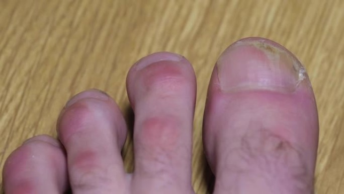 甲癣: 指甲从甲床上脱离。真菌指甲感染。