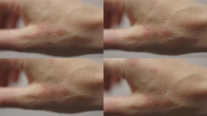 特写湿疹皮炎手部皮肤干裂，拇指过敏状况
