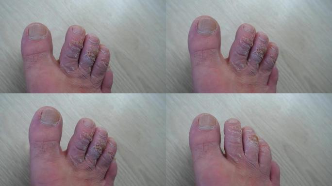 特写足部皮肤病，手指上的愈伤组织形成，脚趾上部的老茧，