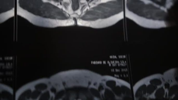 一名男子在家里的窗户上从臀部断层扫描的横向图像中查看细节