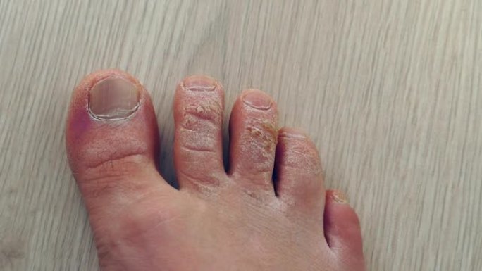 男人脚趾上的近距离骨痂形成，手指上的死皮，