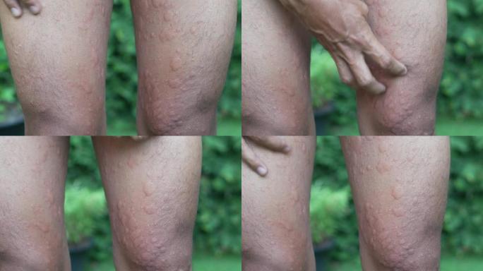 手抓荨麻疹或过敏对她的身体