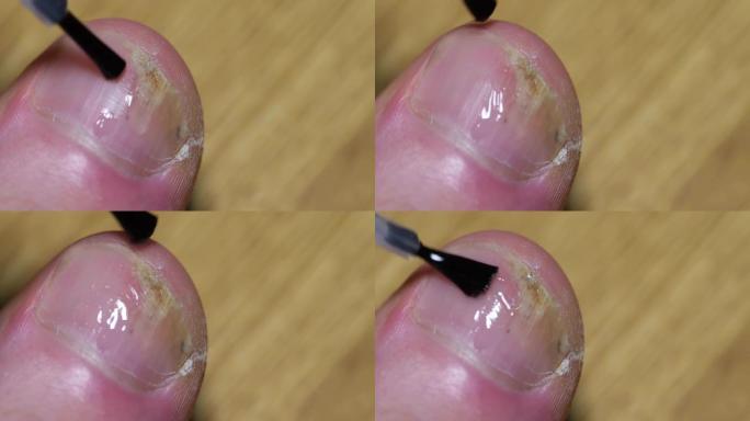 该名男子将抗真菌药物应用于受感染的大脚趾。