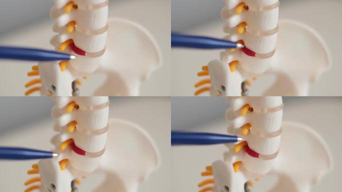 颈椎间疝，纤维环破裂。骨软骨病，复制空间。物理治疗诊所的人体柱塑料模型完整锅