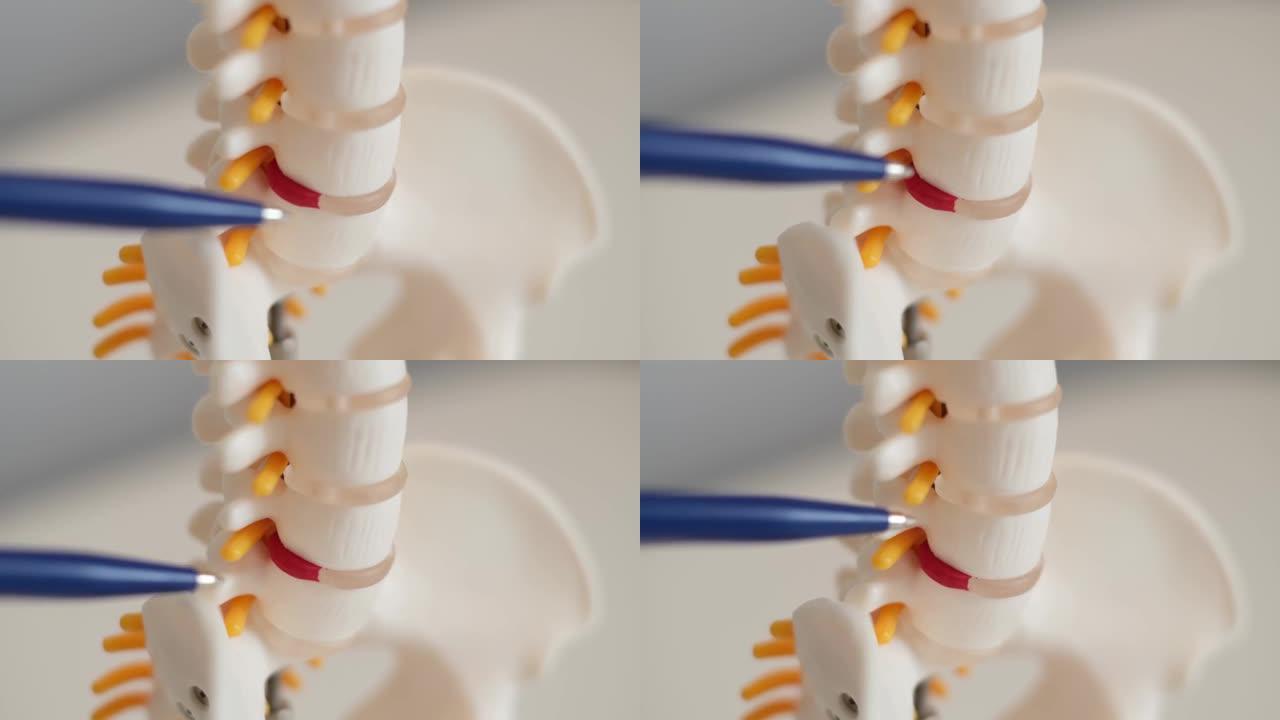 颈椎间疝，纤维环破裂。骨软骨病，复制空间。物理治疗诊所的人体柱塑料模型完整锅