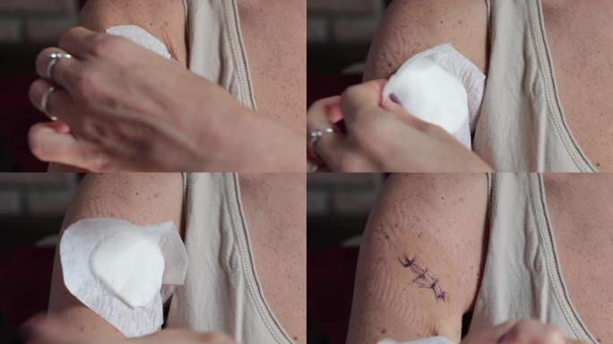 女人正在为家庭用药发现手臂的缝合伤口
