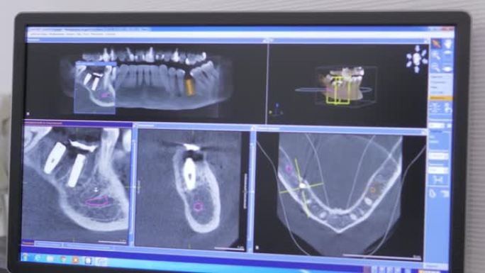 显示器上的患者颌骨和牙齿的x射线图像的特写3d模型，现代牙科诊所的颌骨MRI。牙科植入物的安装。牙科