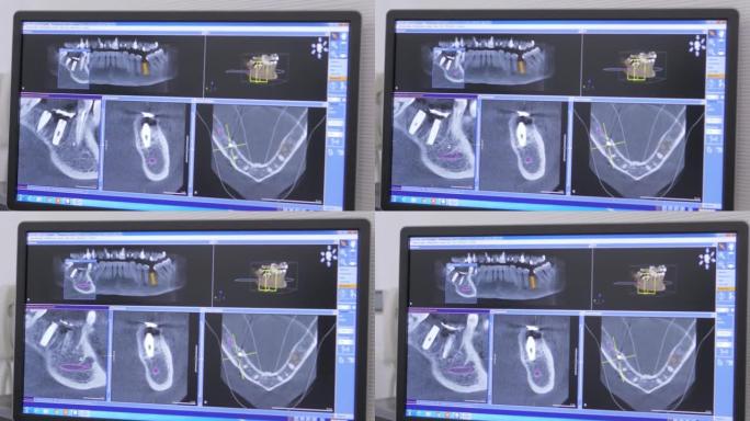 显示器上的患者颌骨和牙齿的x射线图像的特写3d模型，现代牙科诊所的颌骨MRI。牙科植入物的安装。牙科