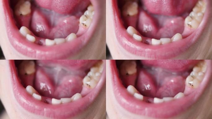 乳牙脱落，折断，变黑，被感染。儿童龋齿