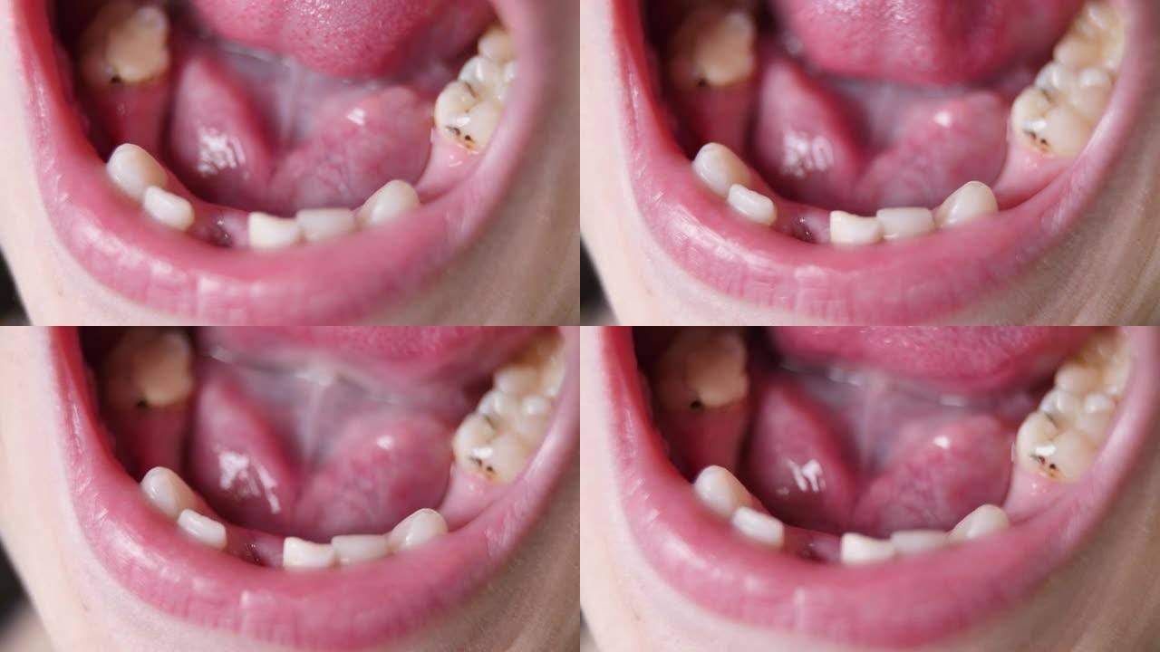 乳牙脱落，折断，变黑，被感染。儿童龋齿