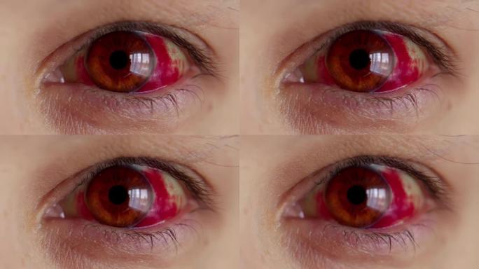 青光眼。女性红眼充满血液。毛细血管破裂，眼白发红，出血。艰难的分娩。过度劳累。压力。体力消耗乏力。压