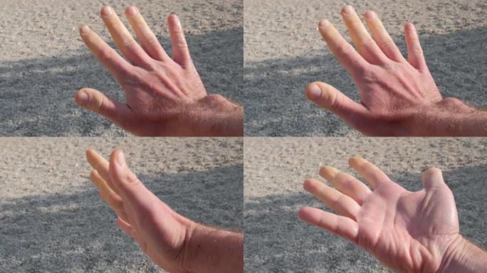 雷诺综合征患者在发作时的手。