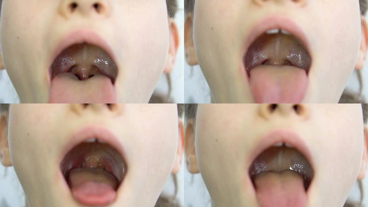 张开嘴巴，伸出舌头，看到小舌和小女孩的软腭，小儿牙科