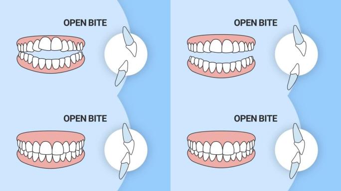 咬合不正。牙齿问题。3d插图。牙科保健概念。