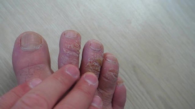 足部皮肤病，手指上的真菌形成，老茧，