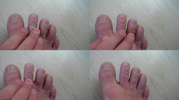 足部皮肤病，手指上的真菌形成，老茧，