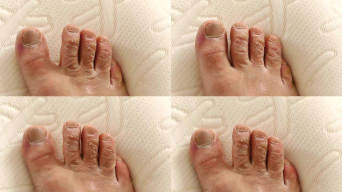 男人脚趾上的近距离骨痂形成，手指上的死皮，