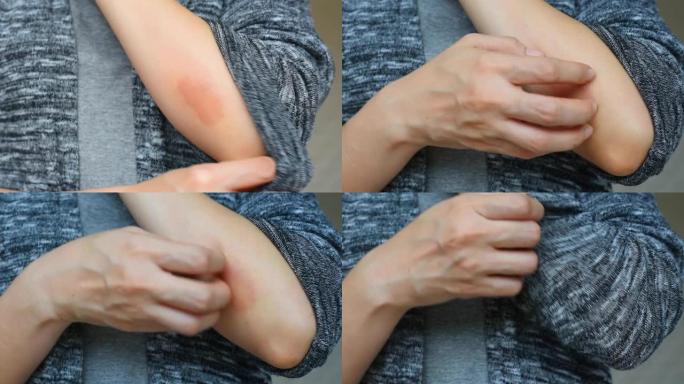 妇女瘙痒皮肤划痕过敏疾病问题，特写特应性皮炎皮疹，女性皮肤科患者手臂过敏性湿疹。