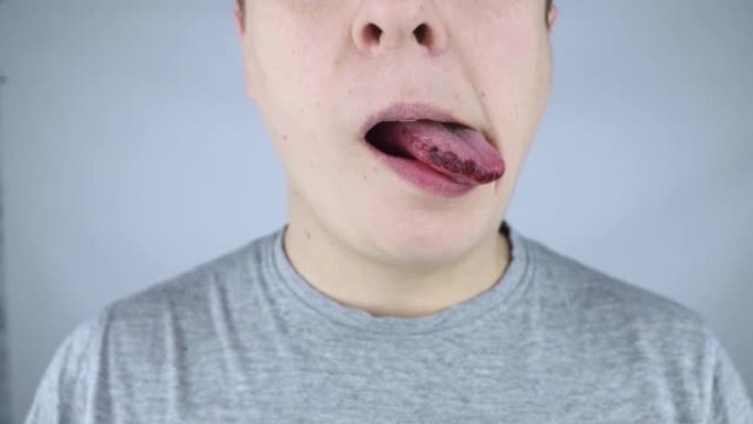 黑色舌头。一个人表现出舌头受伤，咬伤或烧伤的后果。零件损坏。内伤的治疗