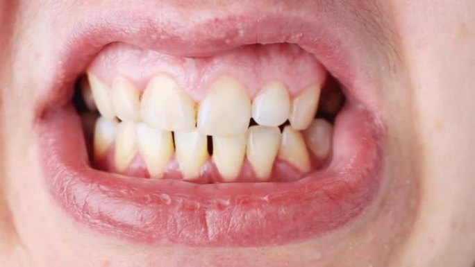 张开的嘴的特写镜头，有咬合不正和牙齿错位。