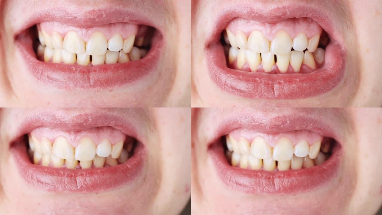 张开的嘴的特写镜头，有咬合不正和牙齿错位。