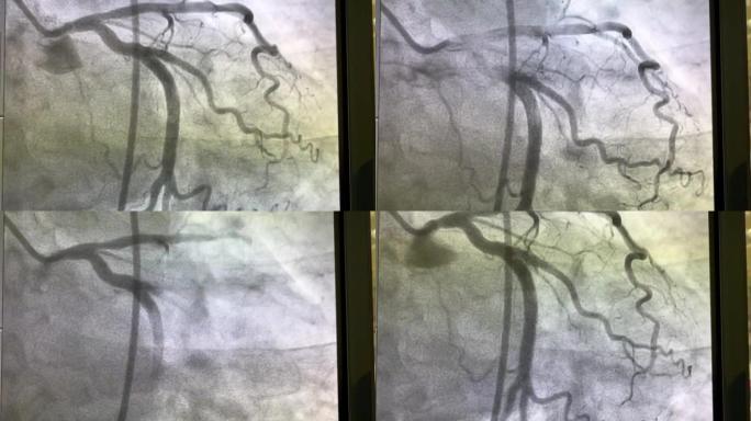 冠状动脉造影术，冠状动脉疾病，冠状动脉造影术