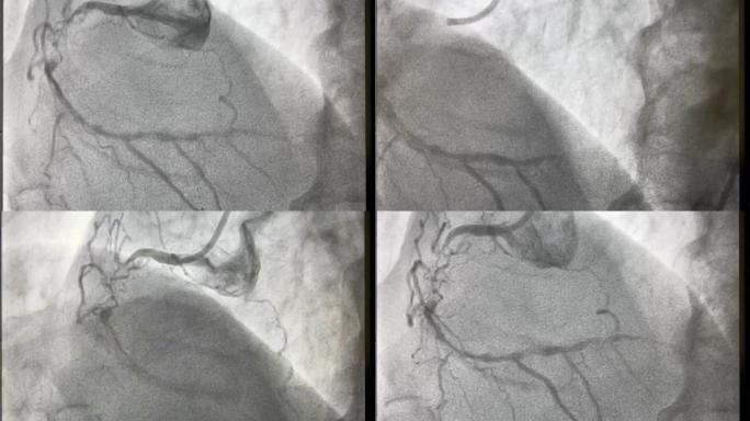 冠状动脉造影术，冠状动脉疾病，冠状动脉造影术