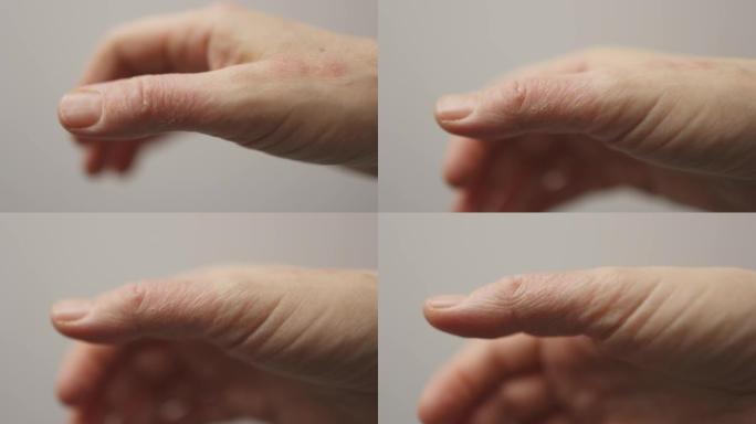特写湿疹皮炎手部皮肤干裂，拇指过敏状况