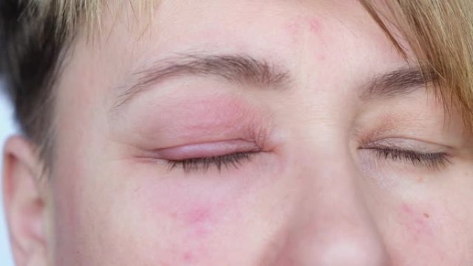 成年女性眼睛发炎的特写镜头。