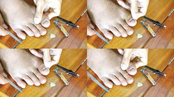 亚洲人从皮肤上割掉腐烂的脚趾甲。