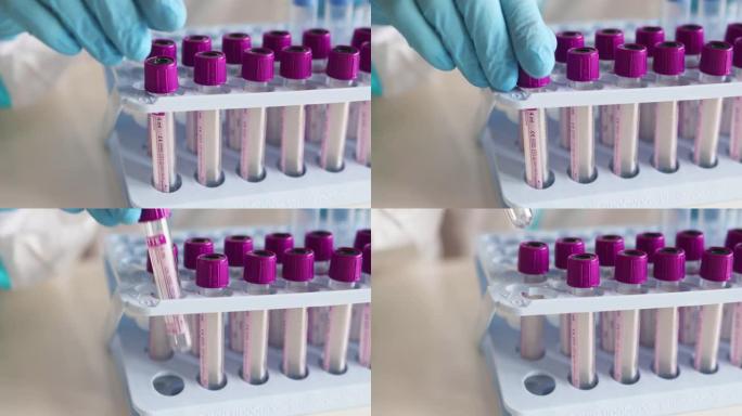实验室护士冠状病毒PCR抗原检测过程，新型冠状病毒肺炎拭子采集试剂盒，OP NP患者标本试管，接受检