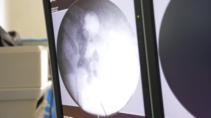 黑白屏幕显示患者内部器官的超声图像。操作过程中的技术辅助。特写。