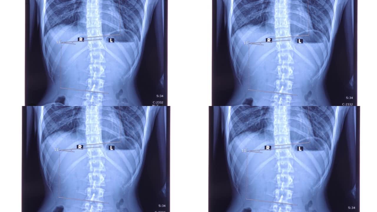 X线显示腰椎侧弯