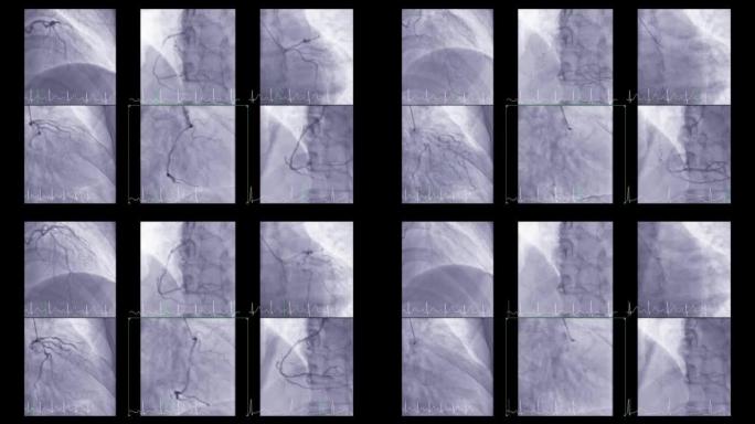 显示冠状动脉的心导管检查以诊断心脏骤停。