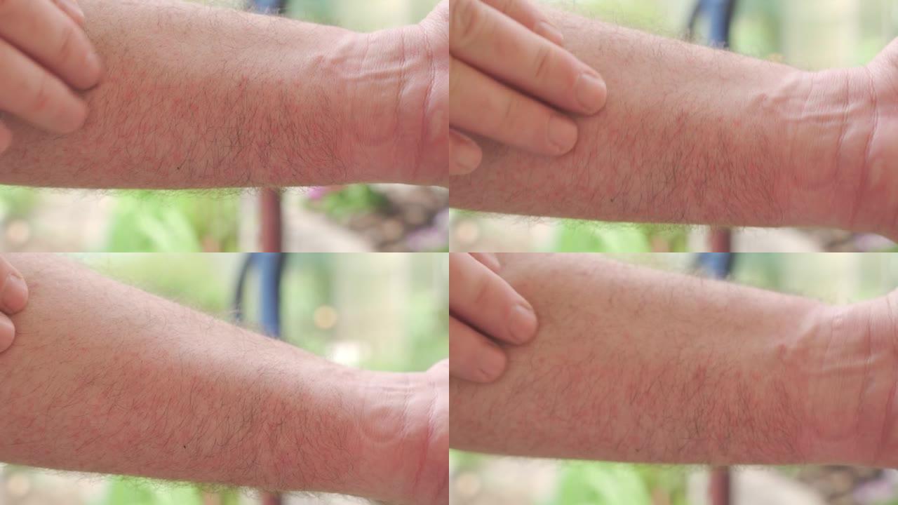 手部皮肤上的刺激和红斑。过敏性皮肤反应，皮疹。特写。
