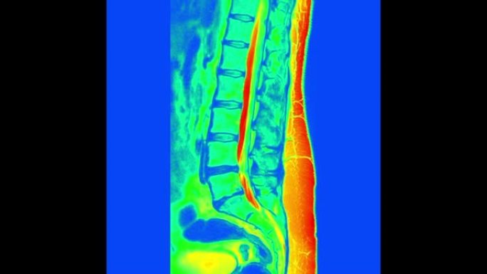 腰椎MR扫描颜色。