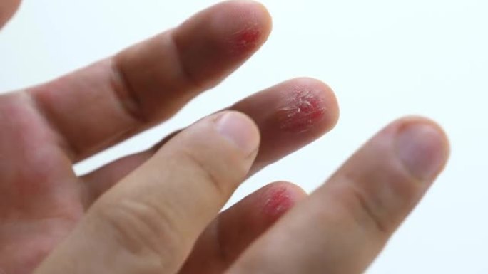 手指受伤的人手掌特写。男性手指上有炎症的皮肤流血伤口。白色背景上手指上的新鲜红色切口。艰苦体力劳动的