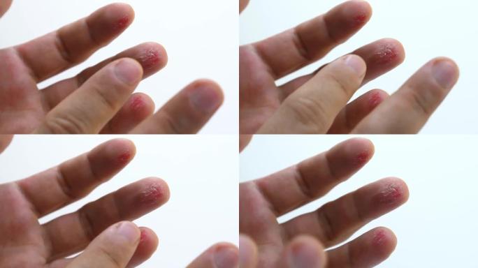 手指受伤的人手掌特写。男性手指上有炎症的皮肤流血伤口。白色背景上手指上的新鲜红色切口。艰苦体力劳动的