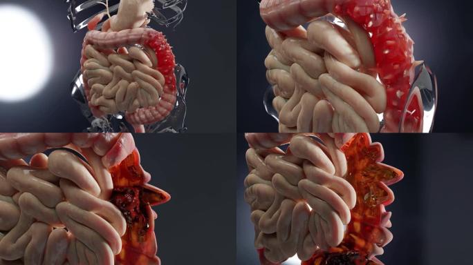 人体消化系统解剖，肠道概念，憩室炎，3d渲染