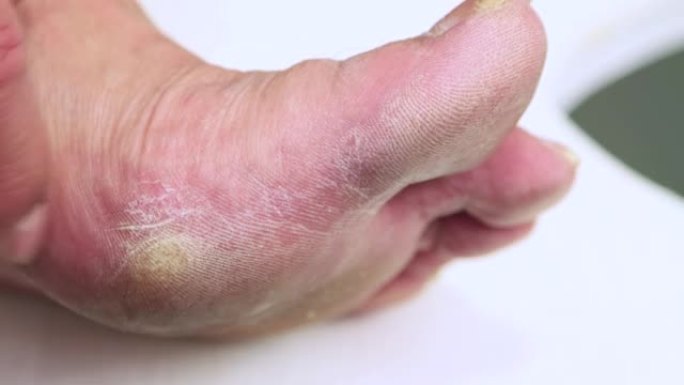 皮肤角质化的大脚趾。