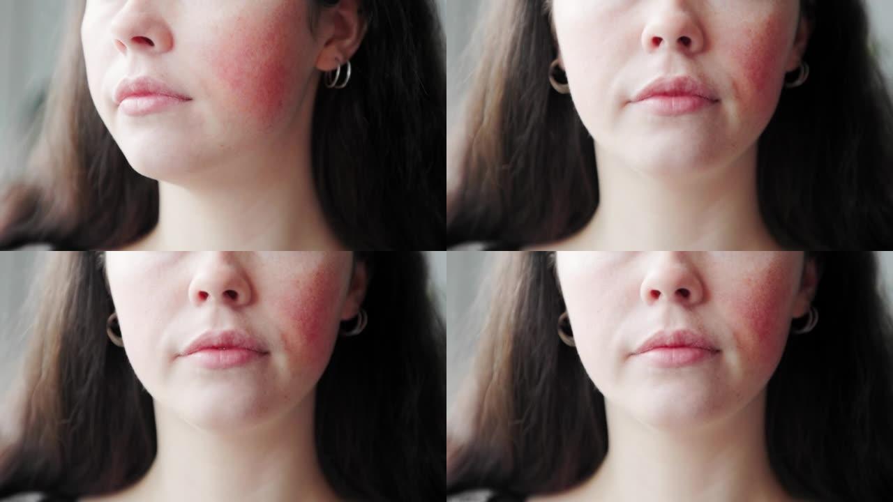 女性脸部特写显示红色脸颊。酒渣鼻和香豆素的概念