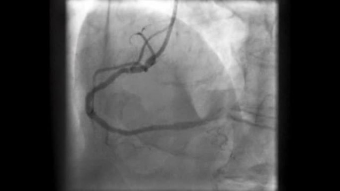 通过荧光检查记录的冠状动脉造影 (x射线运动图像)
