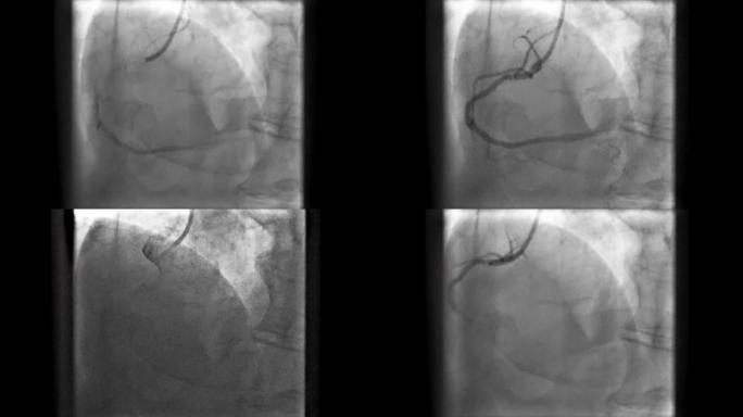 通过荧光检查记录的冠状动脉造影 (x射线运动图像)