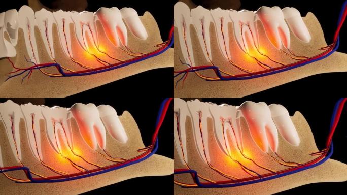 牙痛。牙齿的解剖详细部分。神经发炎。3D动画