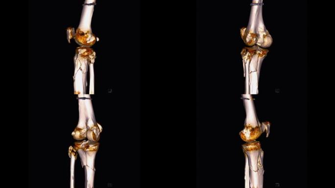 膝关节三维渲染的ct扫描。