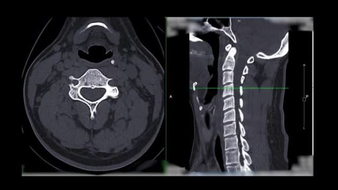 颈椎ct扫描