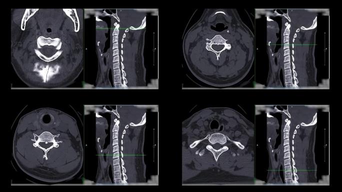 颈椎ct扫描